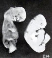Fig. 214. Macerated, distorted single-ovum twins. No. 2258. X2.67.