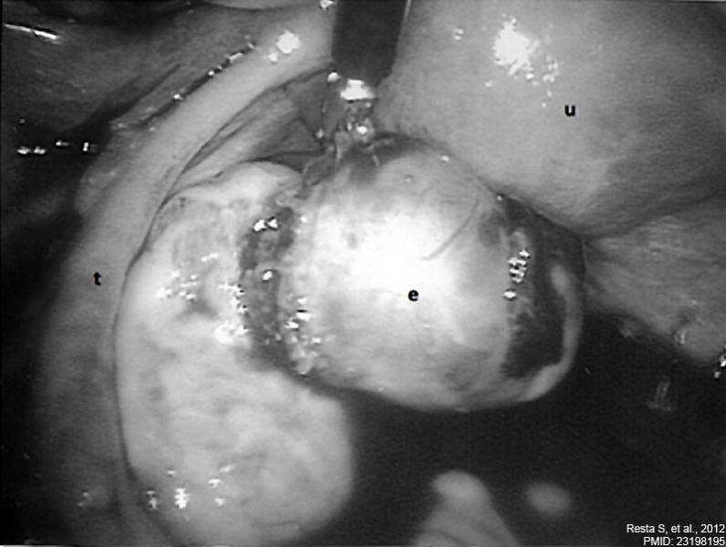 File:Ovarian ectopic pregnancy 01.jpg