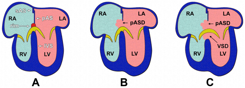 File:Stages of Atrial Septation.png