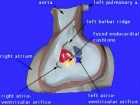 Heart-ventricular-septum-02.jpg