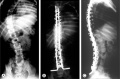 Spinal deformity in DMD