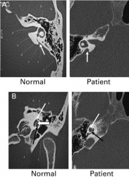 Pendred Syndrome Showing Mondini Defects.jpg