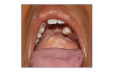 Repaired cleft palate
