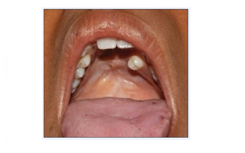 File:Repaired Cleft Palate.PNG