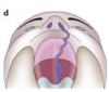 Unilateral cleft lip with cleft hard and soft palate.jpg