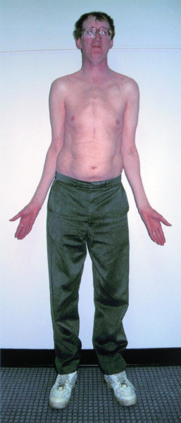 File:Patient with Marfan syndrome.jpg