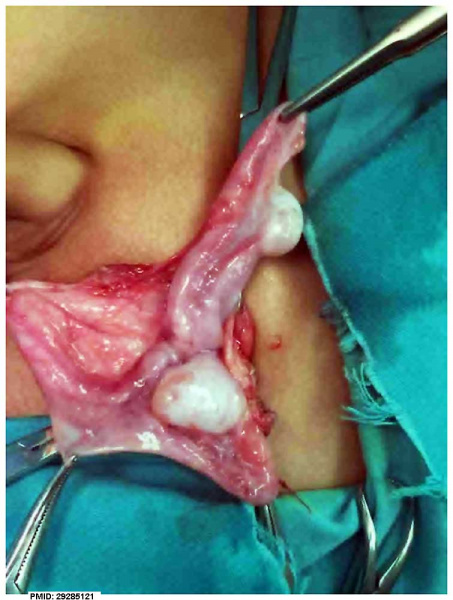 File:Persistent Mullerian duct syndrome 01.jpg