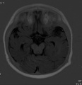 Fig 28 Partial Rhombencephalosynapsis with fused upper parts of the cerebellum