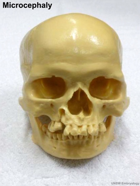 File:Skull - microcephaly 01.jpg