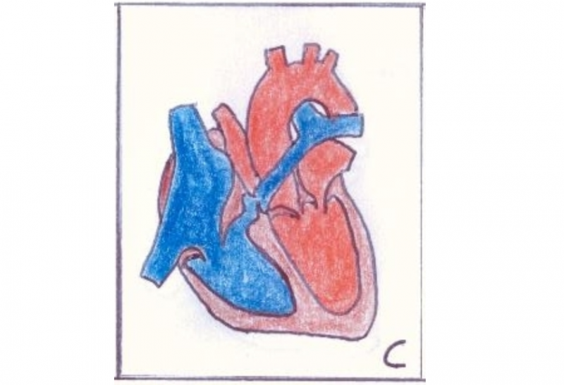 File:Obstruction of Right Ventricular Heart Flow.PNG