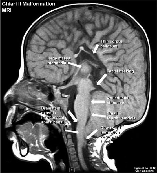 File:Chiari II malformation MRI02.jpg