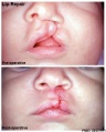 Cheiloplasty - surgical repair of the lip