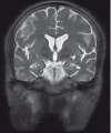 Neuroacanthocytosis.jpg