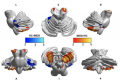 Fig 30 gray matter density in the cerebellar subregions.