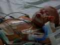 Baby with Tetralogy of Fallot- The morning after surgery