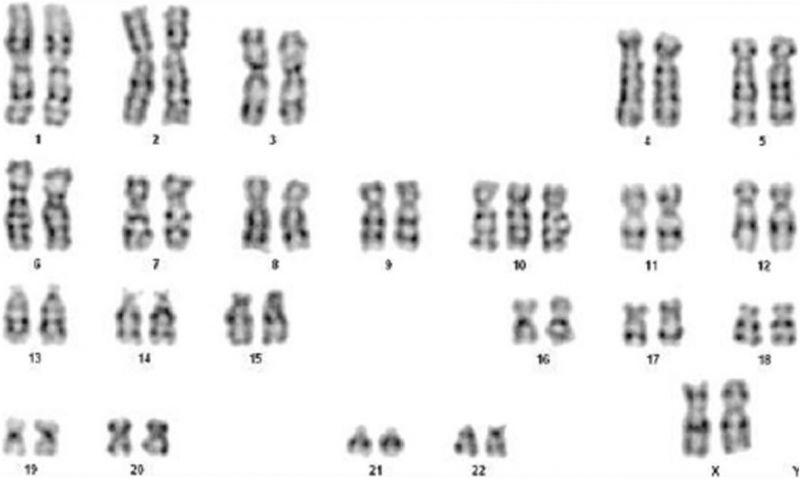 File:Trisomy 10 mosaicism karyotype.jpg