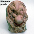 Birth (placenta previ)