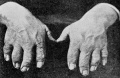 Fig. 65. Two Brachydactyl hands