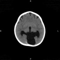 MRI holoprosencephaly Z5019880 Reference, copyright and student template, relevant to project.