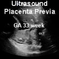 US Placenta Previa GA33week icon.jpg