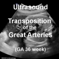 US Transposition great arteries.jpg
