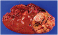 Macroscopic image hepatocellular carcinoma