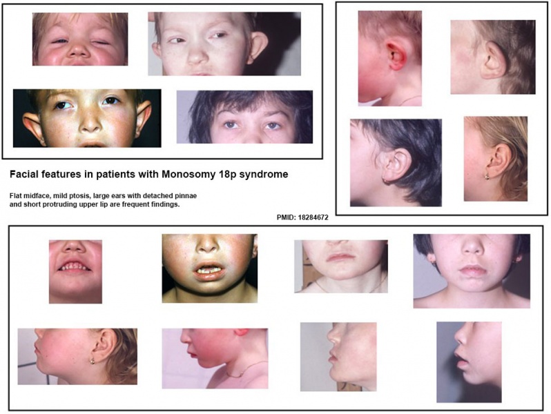File:Monosomy 18p syndrome facial features.jpg