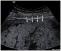 Ultrasound placenta accreta retroplacental clear space loss