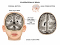 Fig 18. Coronal and axial sections of the brain of a patient with Schizencephaly