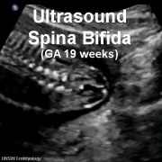 Template:Ultrasound Spina-Bifida - Embryology