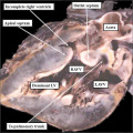 fig 10 Human ventricular septal defect