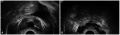 Z3462297 Midline Prostatic Cyst in Ejaculatory Duct Obstruction. Image summary could have included additional descriptive information.