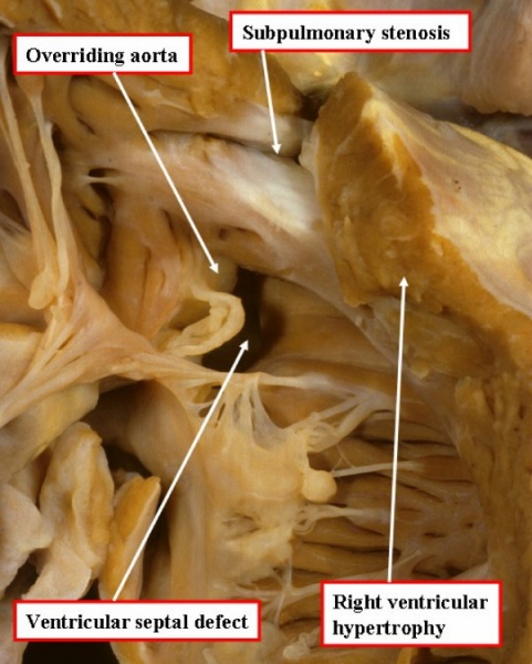 File:Right ventricle of heart with Tetralogy of Fallot.jpg