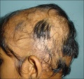 alopecia areata Z3417843 Figure relates to project topic contains reference, copyright and student template. Why is there no additional description of the abnormality in the caption.