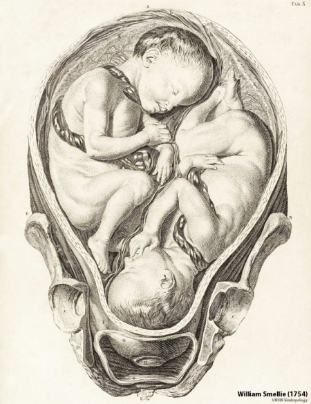 Abnormal Development - Twinning - Embryology