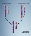 Chromosome unbalanced translocation
