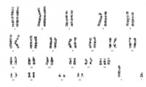 Karyotype Trisomy 18 male