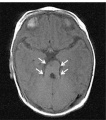 Fig 26 Brain Imaging of Joubert Syndrome