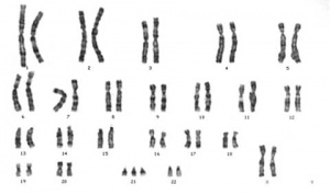 Female Trisomy 21 Karyotype