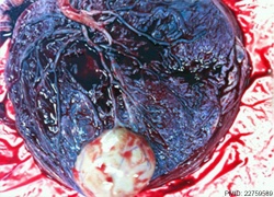 Placental chorioangioma 02.jpg
