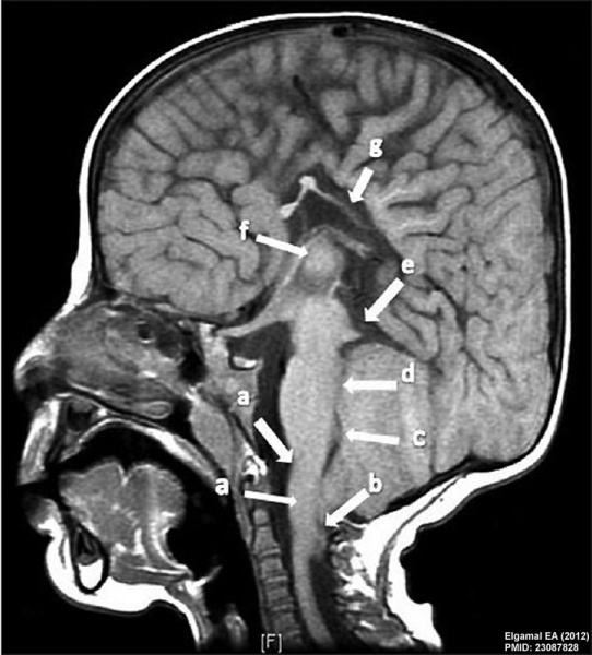 File:Chiari II malformation MRI01.jpg