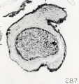 Fig. 287. A villous nodule completely surrounded by stroma, except at its free surface not shown in the figure. No. 556.