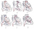 Fetal blood flow in a normal heart and in a Tetralogy of Fallot heart