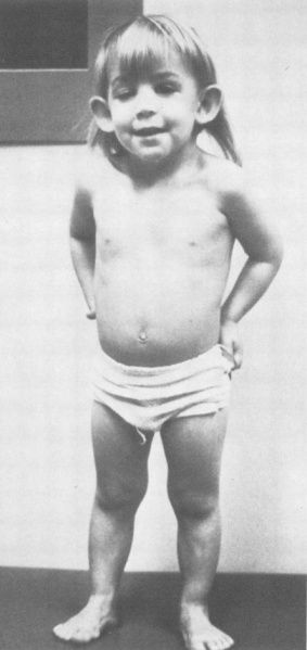 File:Turners syndrome 4 year old child.jpg