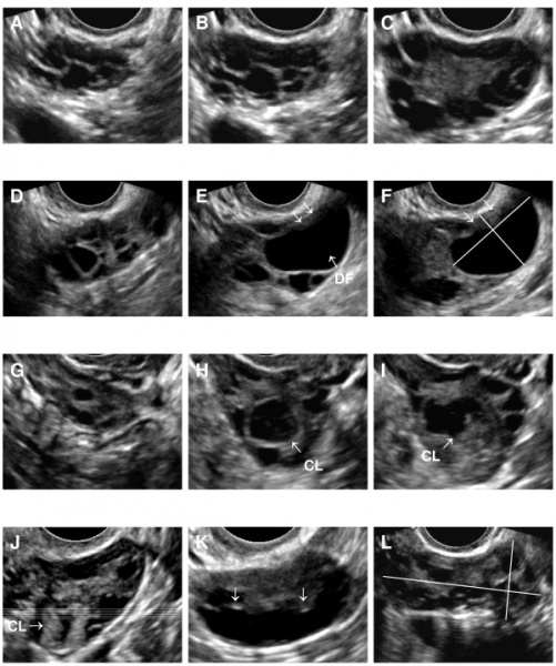 File:Ultrasound of Polycystic Ovaries .jpg