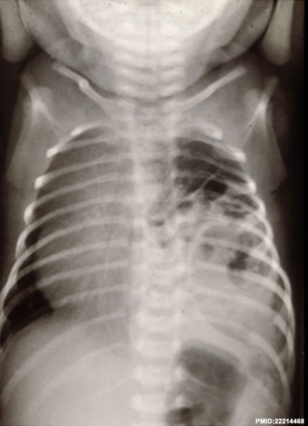 File:Congenital diaphragmatic hernia 02.jpg