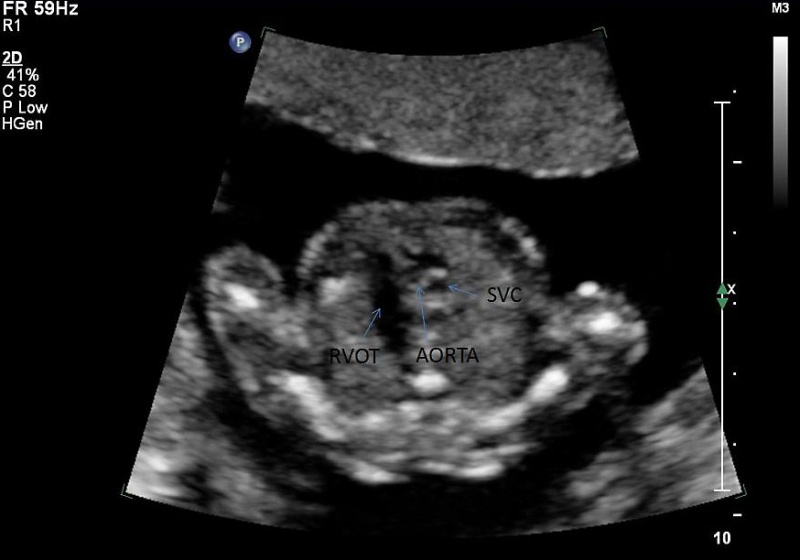 File:Ultrasound - Hypoplastic left heart syndrome 03.jpg
