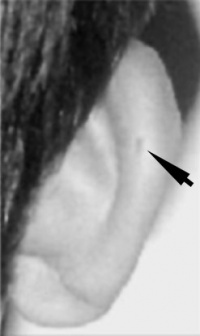 Beckwith-Wiedemann syndrome posterior helix pit.jpg