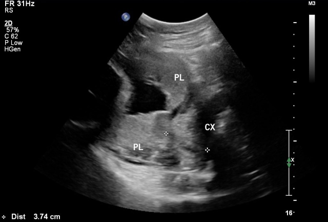 Ultrasound placenta previa 01.jpg