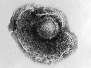 varicella zoster virus